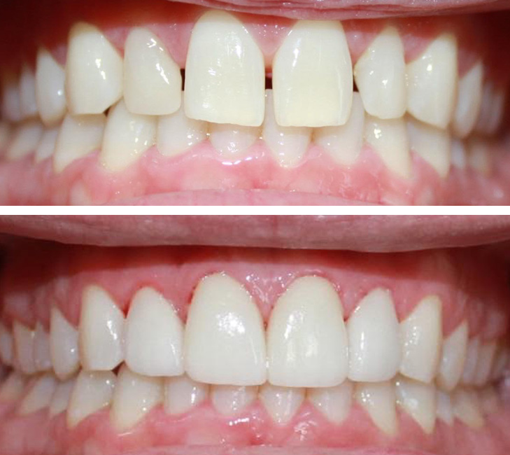 Before/After Dental Smile Gallery - Redondo Beach Dentist Cosmetic and Family Dentistry