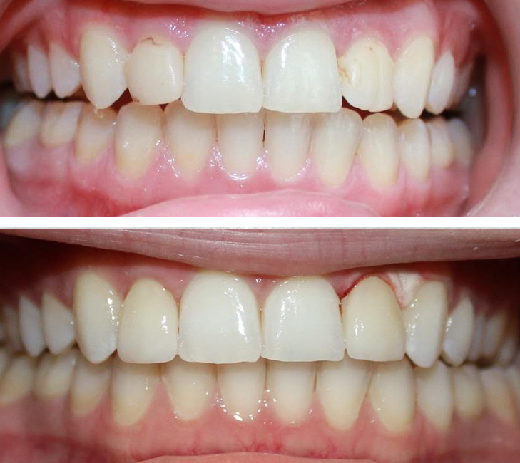 Before/After Dental Smile Gallery - Redondo Beach Dentist Cosmetic and Family Dentistry